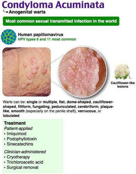 Condyloma acuminata
